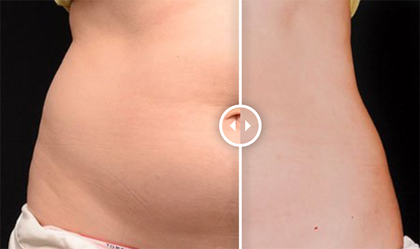 experiencia coolsculpting