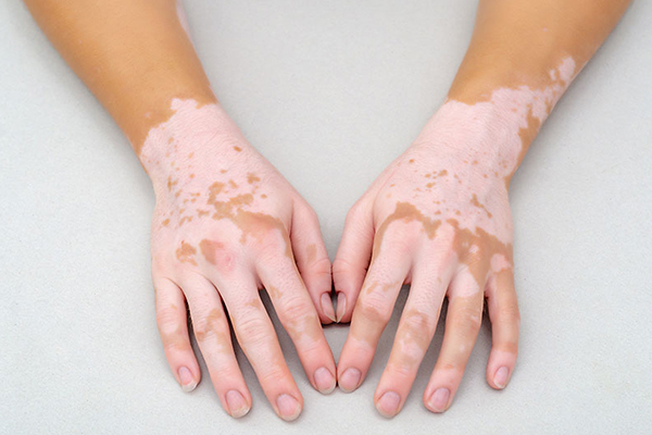 manchas blancas en la piel del sol manchas blancas en la piel del sol