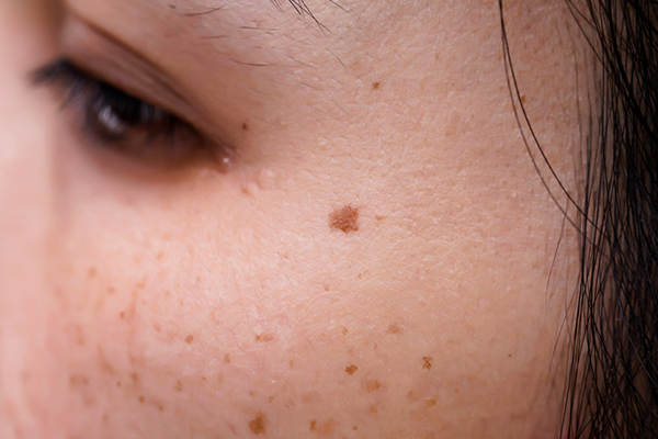 manchas en la piel por el sol imagenes manchas en la piel por el sol imagenes