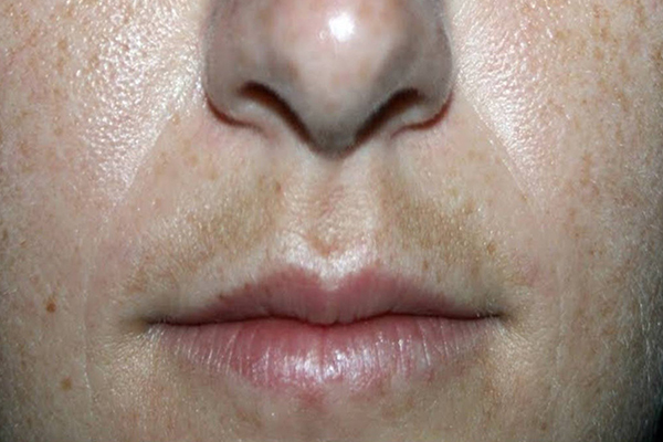 manchas negras en la piel manchas negras en la piel