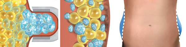precio tratamiento criolipolisis